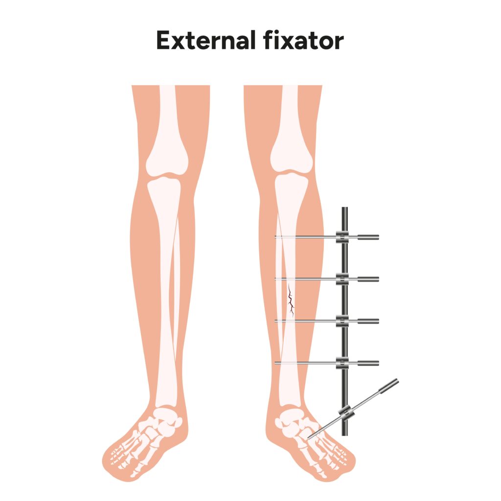External fixator diagram for limb lengthening surgery