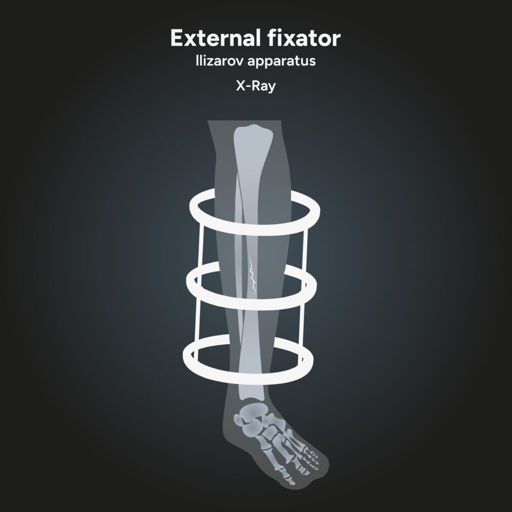 Ilizarov external fixator diagram for tibia lengthening procedure