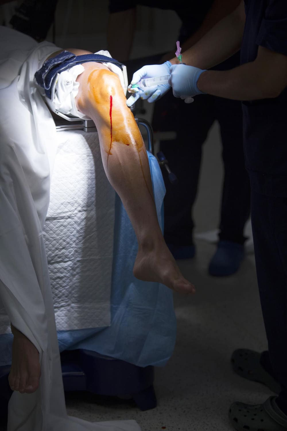 Limb lengthening surgery procedure on a patient’s leg