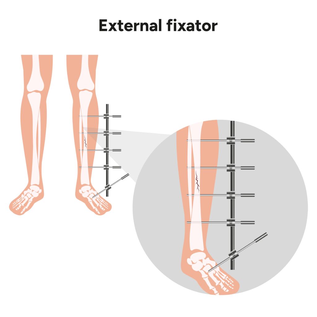 cost of limb lengthening surgery external fixator