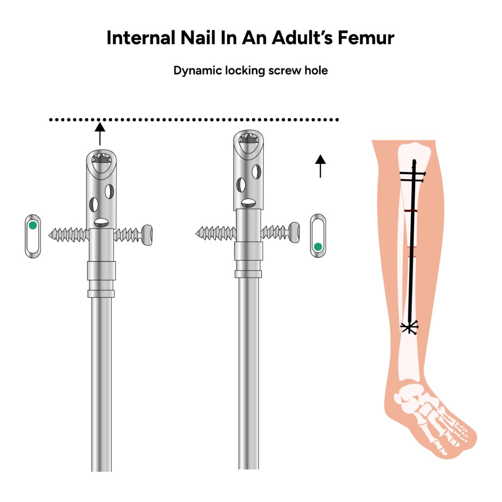 internal nail in an adult femur