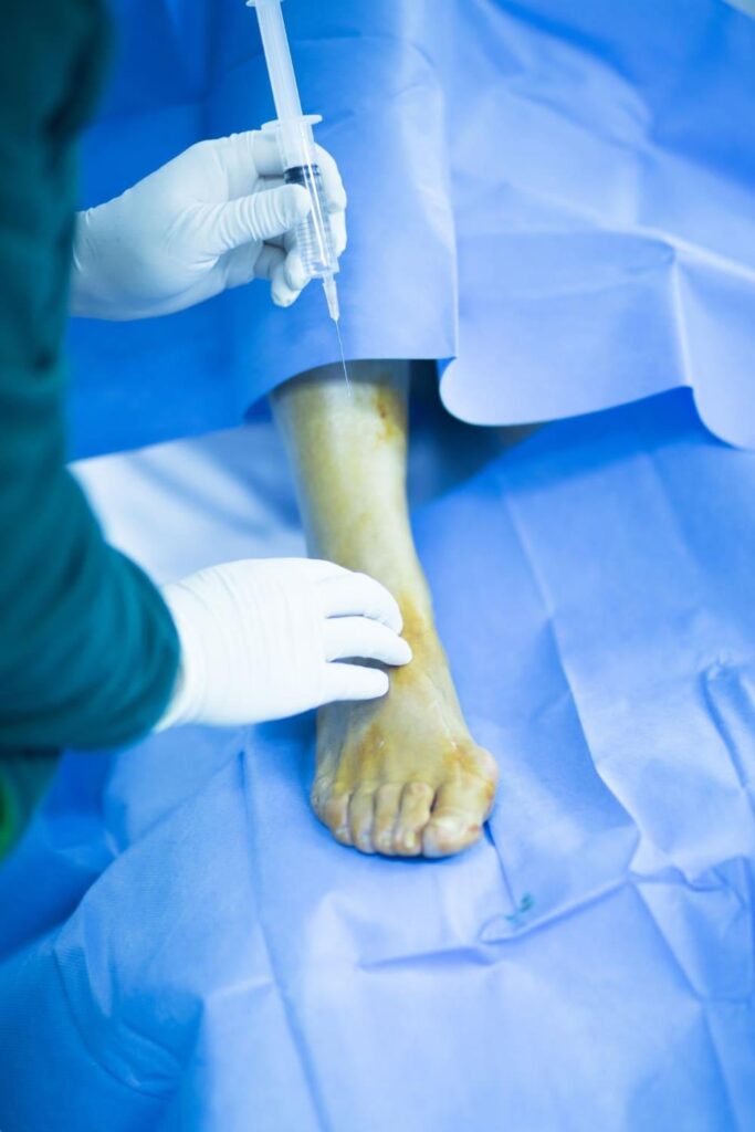 Surgeon administering anesthesia to a prepped foot before bunion surgery