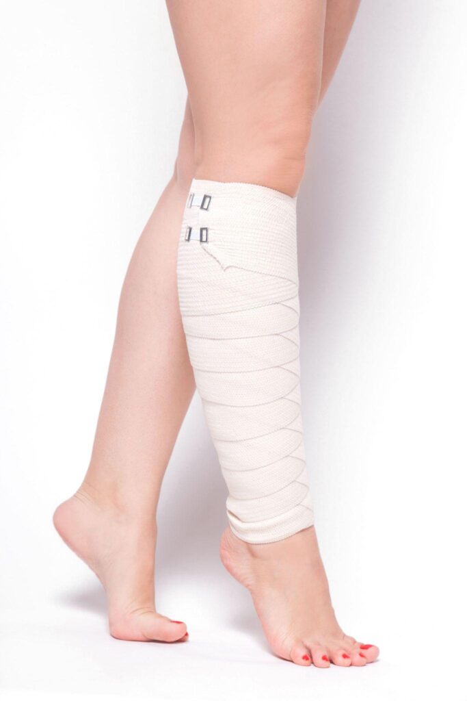 Lower leg wrapped in a compression bandage after orthopedic limb surgery